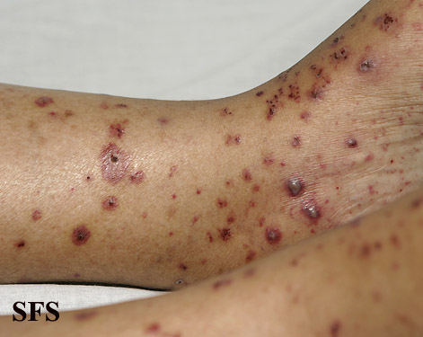 Allergic Vasculitis (Dermatology Atlas 10).jpg