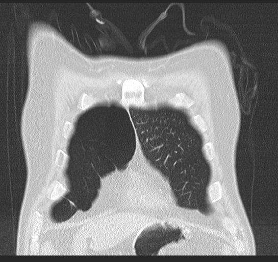 Allergic bronchopulmonary aspergillosis (Radiopaedia 44760-48571 Coronal lung window 12).png