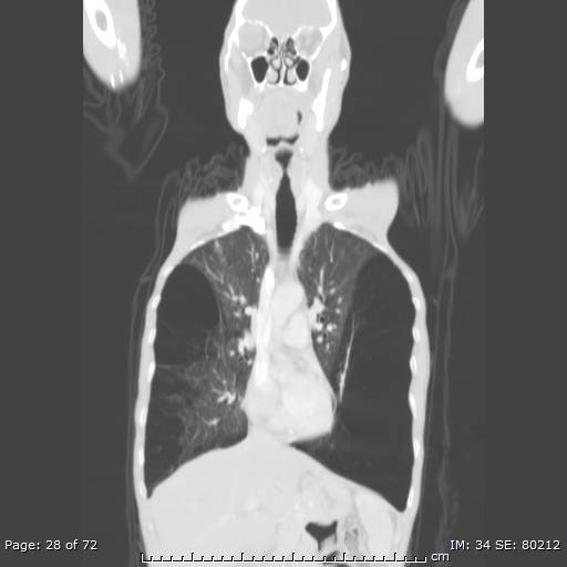 Alpha-1-antitrypsin deficiency (Radiopaedia 50561-55987 Coronal lung window 26).jpg