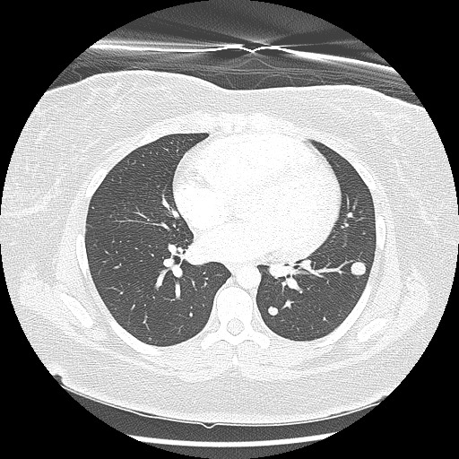 Alveolar soft part sarcoma - right leg (Radiopaedia 59432-67091 Axial lung window 64).jpg