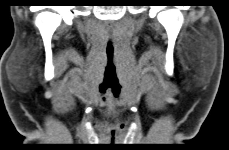 Ameloblastoma (Radiopaedia 33677-34806 Coronal non-contrast 39).png