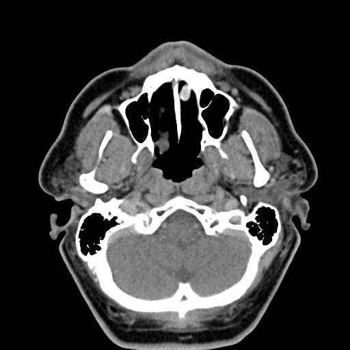 File:Ameloblastoma (Radiopaedia 38520-40623 Axial non-contrast 18).png