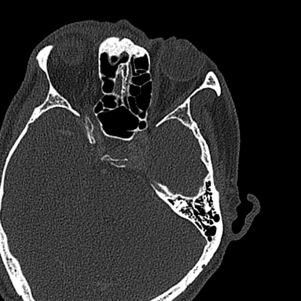 Ameloblastoma (Radiopaedia 51921-57766 Axial bone window 176).jpg