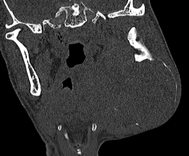 Ameloblastoma (Radiopaedia 51921-57766 Coronal bone window 163).jpg