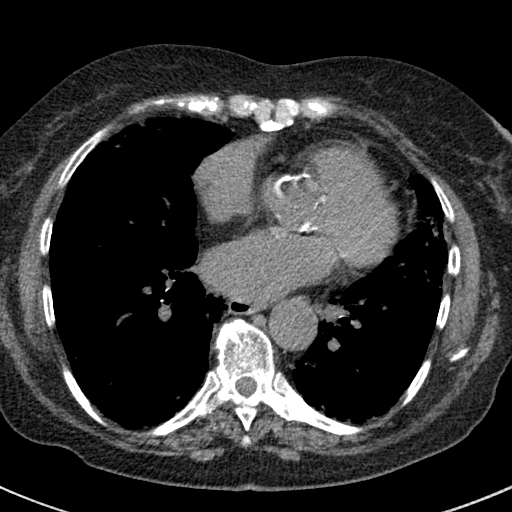 File:Amiodarone-induced pulmonary fibrosis (Radiopaedia 82355-96460 Axial non-contrast 38).jpg