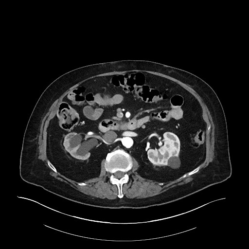 Ampullary adenocarcinoma (Radiopaedia 59373-66734 A 71).jpg