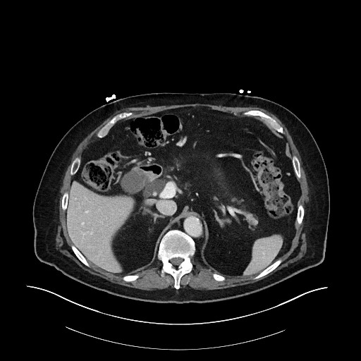 Ampullary adenocarcinoma (Radiopaedia 59373-66734 C 47).jpg