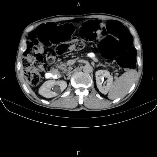 Ampullary adenocarcinoma (Radiopaedia 86093-102032 Axial C+ delayed 35).jpg