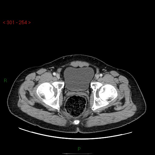Ampullary carcinoma (Radiopaedia 56396-63056 C 97).jpg