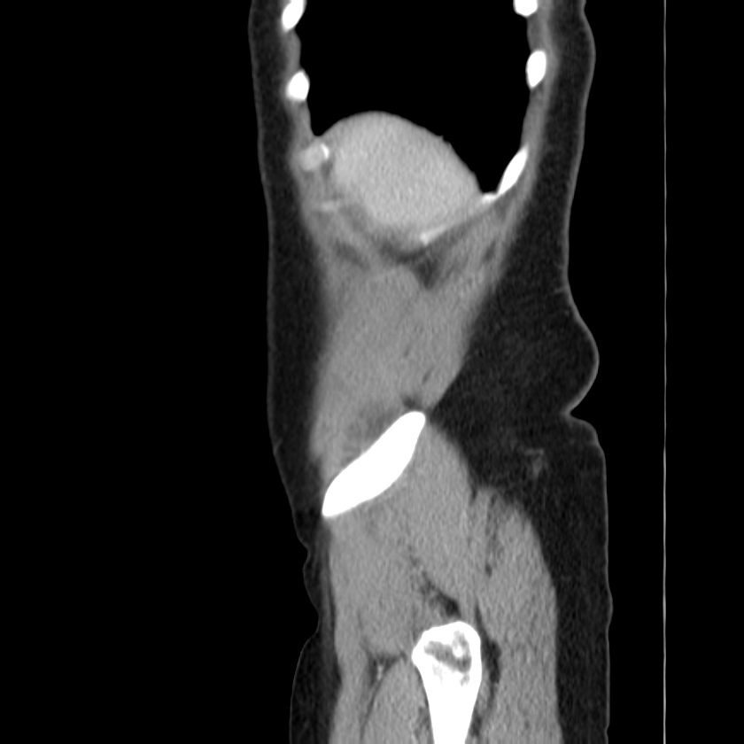Ampullary tumor (Radiopaedia 22787-22816 D 6).jpg