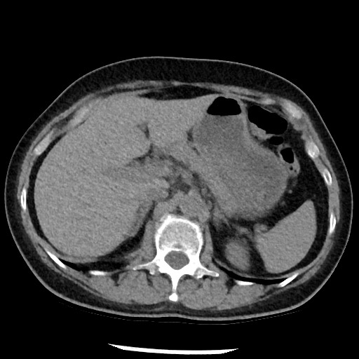 Amyloidosis - bronchial and diffuse nodular pulmonary involvement (Radiopaedia 60156-67744 Axial non-contrast 57).jpg