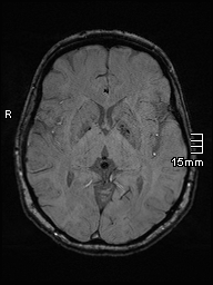 Amyotrophic lateral sclerosis (Radiopaedia 70821-81017 Axial SWI 25).jpg