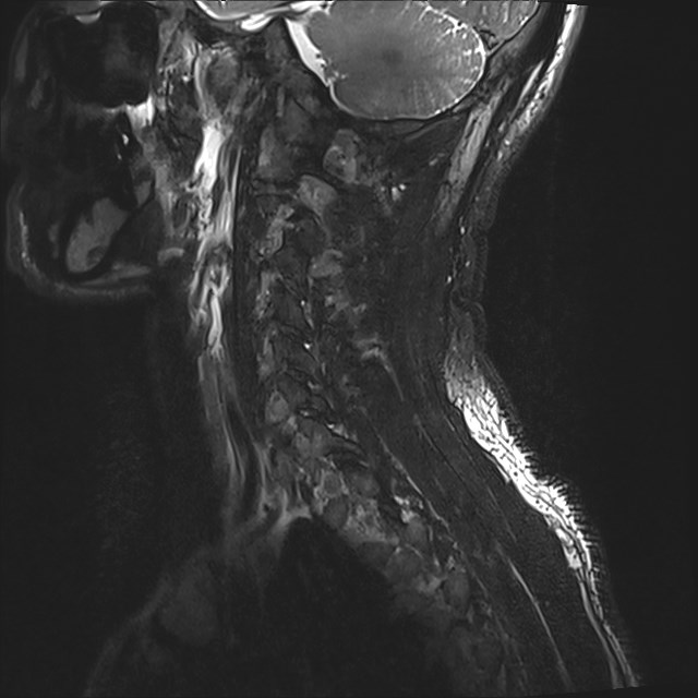 Amyotrophic lateral sclerosis (Radiopaedia 87352-103658 I 4).jpg