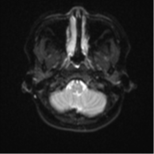 Anaplastic astroblastoma (Radiopaedia 55666-62194 Axial DWI 4).png