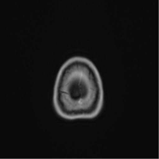 Anaplastic astroblastoma (Radiopaedia 55666-62194 Axial T1 C+ 74).png