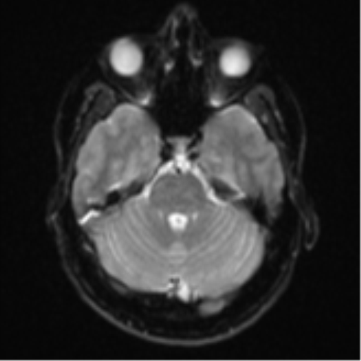 Anaplastic astrocytoma (Radiopaedia 57768-64731 Axial DWI 8).png
