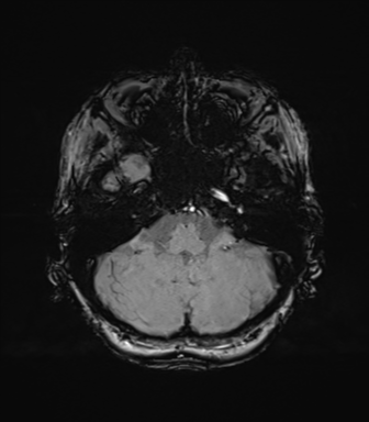 Anaplastic astrocytoma (Radiopaedia 86943-103160 Axial SWI 22).png