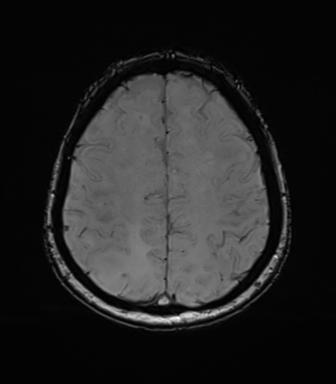 File:Anaplastic astrocytoma (Radiopaedia 86943-103160 Axial SWI 67).png