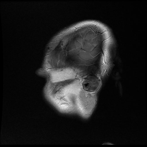 File:Anaplastic astrocytoma (WHO grade III) (Radiopaedia 23559-23664 Sagittal T1 C+ 19).jpg