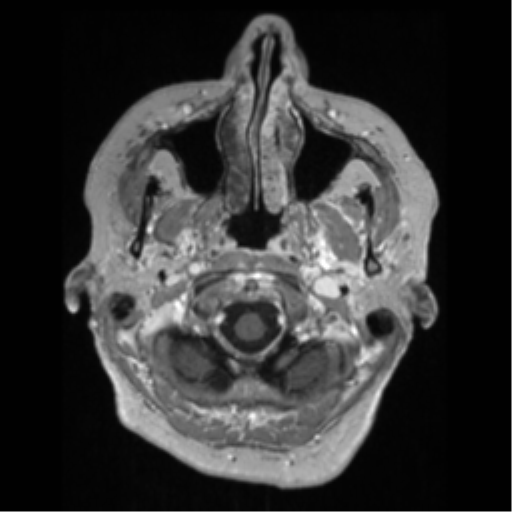 Anaplastic astrocytoma IDH wild-type (pseudoprogression) (Radiopaedia 42209-45276 Axial T1 C+ 17).png