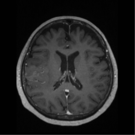 File:Anaplastic astrocytoma IDH wild-type (pseudoprogression) (Radiopaedia 42209-45276 Axial T1 C+ 89).png
