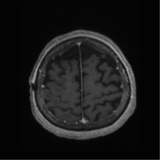 File:Anaplastic astrocytoma IDH wild-type (pseudoprogression) (Radiopaedia 42209-45277 Axial T1 C+ 105).png
