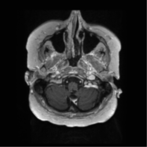 File:Anaplastic astrocytoma IDH wild-type (pseudoprogression) (Radiopaedia 42209-45279 Axial T1 C+ 20).png