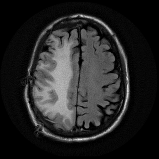 File:Anaplastic meningioma with recurrence (Radiopaedia 34452-35791 Axial FLAIR 16).png
