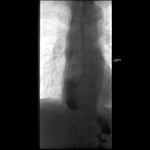 File:Anastomotic stricture post Ivor Lewis esophagectomy (Radiopaedia 47937-52715 C 13).png