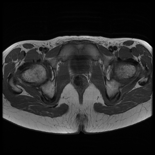 File:Androgen insensitivity syndrome (Radiopaedia 38585-40727 Axial T1 21).jpg
