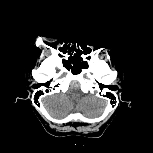 Aneursym related subarachnoid hemorrhage with hydrocephalus (Radiopaedia 45105-49083 Axial non-contrast 5).jpg
