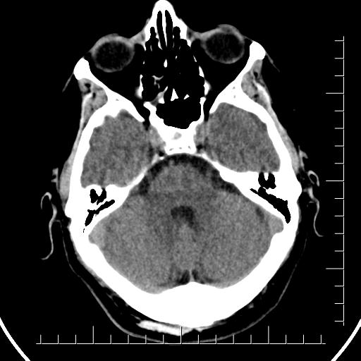 Aneurysm of posterior communicating artery (Radiopaedia 20188-20162 Axial non-contrast 13).jpg