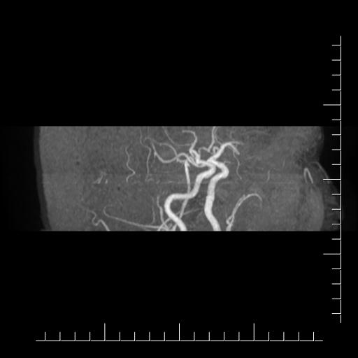 File:Aneurysm of posterior communicating artery (Radiopaedia 20188-20163 MRA 18).jpg