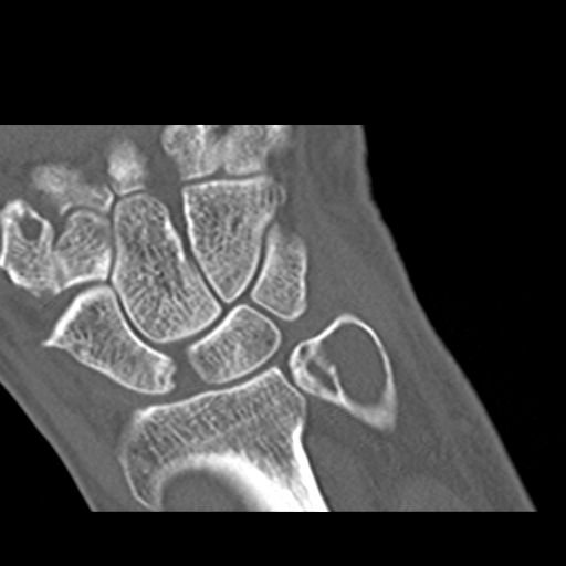 File:Aneurysmal bone cyst (Radiopaedia 16847-16570 Coronal bone window 9).jpg