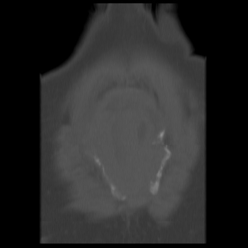 File:Aneurysmal bone cyst - sacrum (Radiopaedia 65190-74195 Coronal bone window 15).jpg
