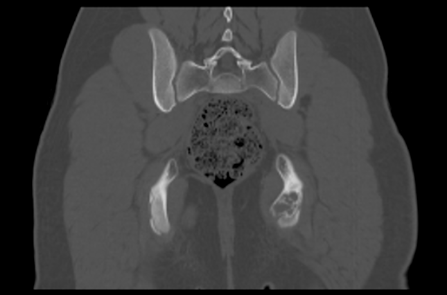 File:Aneurysmal bone cyst of ischium (Radiopaedia 25957-26094 Coronal bone window 34).png