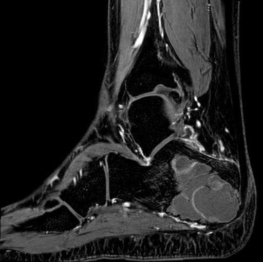 File:Aneurysmal bone cyst of the calcaneus (Radiopaedia 60669-68420 F 12).jpg