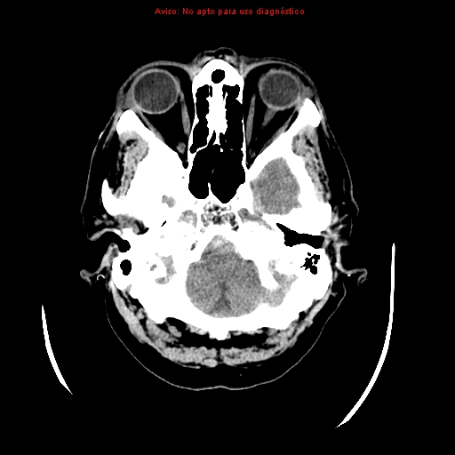 File:Aneurysmal subarachnoid hemorrhage (Radiopaedia 24740-24997 Axial non-contrast 7).jpg