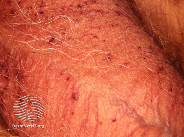 File:Angiokeratoma of Fordyce on scrotum (DermNet NZ angiokeratoma-33).jpg