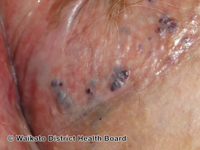 File:Angiokeratoma of Fordyce on vulva (DermNet NZ angiokeratoma-24).jpg