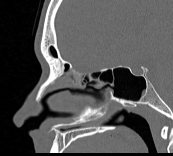 Angular epidermoid cyst (Radiopaedia 46908-51439 Sagittal bone window 40).png