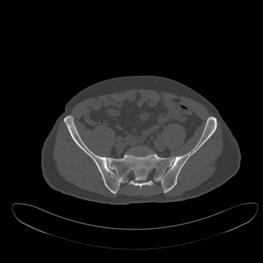 Ankylosing spondylitis (Radiopaedia 52728-58645 Axial bone window 21).jpg