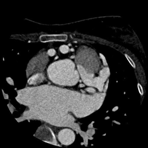 File:Anomalous left coronary artery from the pulmonary artery (ALCAPA) (Radiopaedia 40884-43586 A 19).jpg