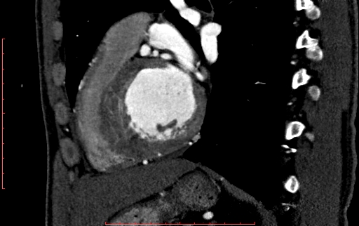Anomalous left coronary artery from the pulmonary artery (ALCAPA) (Radiopaedia 70148-80181 C 164).jpg