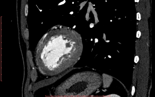 Anomalous left coronary artery from the pulmonary artery (ALCAPA) (Radiopaedia 70148-80181 C 210).jpg