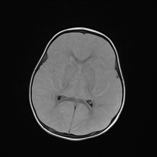 File:Anoxic brain injury (Radiopaedia 79165-92139 Axial FLAIR 15).jpg