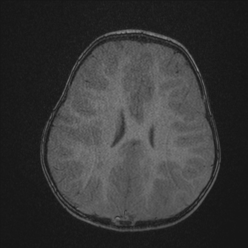 File:Anoxic brain injury (Radiopaedia 79165-92139 Axial MRA 171).jpg