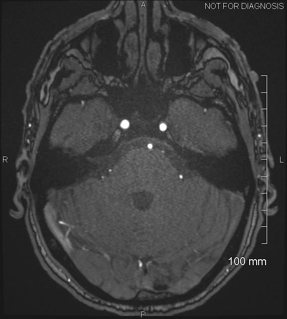 Anterior cerebral artery aneurysm (Radiopaedia 80683-94127 Axial MRA 62).jpg
