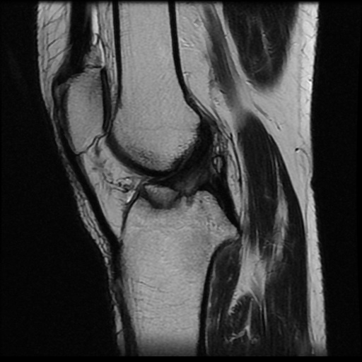 File:Anterior cruciate ligament avulsion fracture (Radiopaedia 58939-66193 Sagittal T2 11).jpg