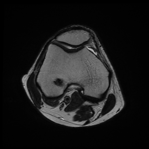 File:Anterior cruciate ligament graft tear and bucket-handle tear of medial meniscus (Radiopaedia 75867-87254 Axial T2 17).jpg